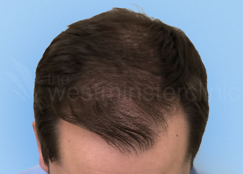 Caucasian Hair Transplant Westminster Clinic