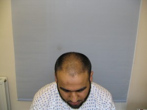 Asian hair transplant before