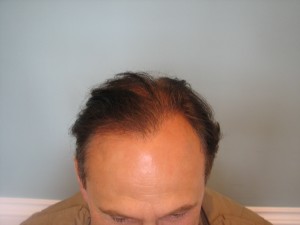 Bald hair transplants and treatments