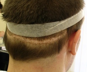 hair transplant scar repair
