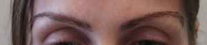 after eyebrow transplant