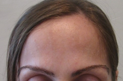 Eyebrow hair transplant