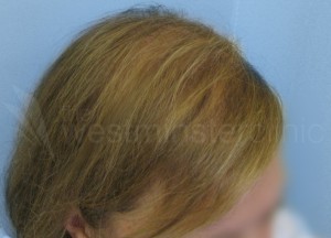 female hair transplants, female hair transplant, transplant women hair loss