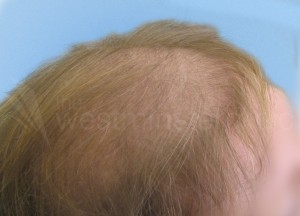 female hair transplant, female hair transplants, hair transplants in women