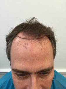 Dr Rogers hairline transplant