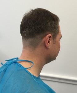 Dr Rogers FUE hair transplant shaved