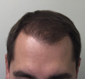 after hair transplant