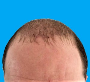 Norwood 6 bald, 2500 FUT grafts