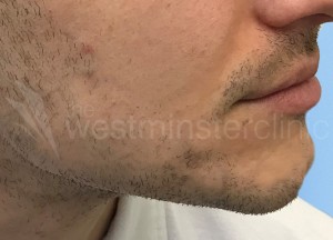 Beard hair transplant
