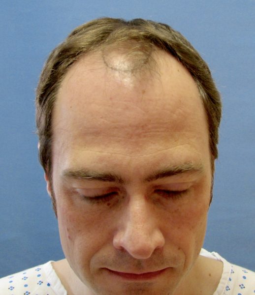 Dr Rogers before his FUT hair transplant