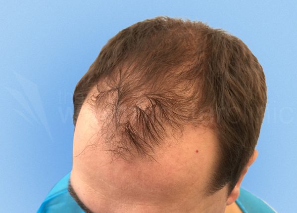 Stemvita stem cell treatment