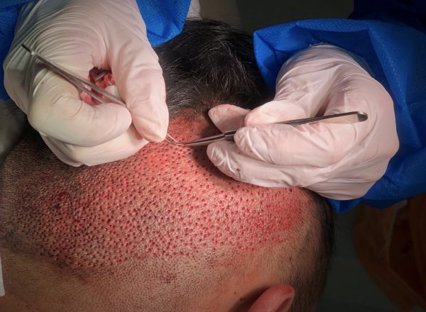 Shaved FUE with old punch