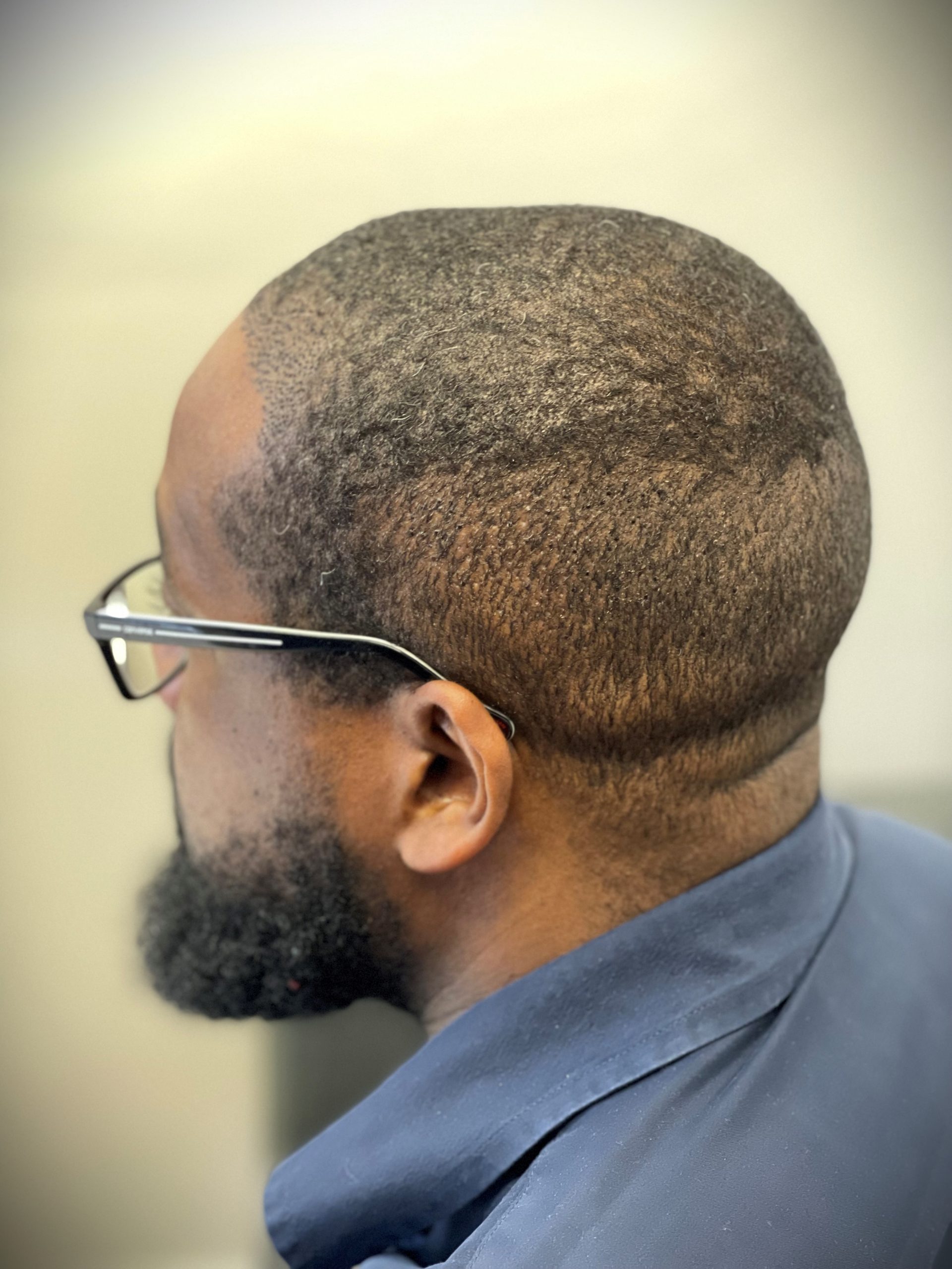 Afro donor seven days after fue